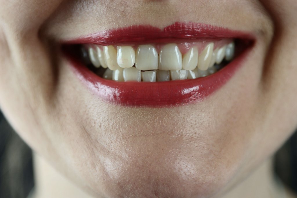 歯並びが悪いけど可愛い人とは 歯列矯正した方がいいタイプを紹介 マウスピース矯正研究所