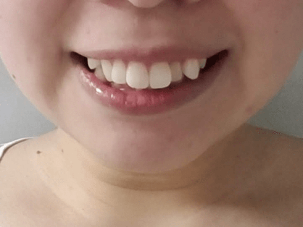 歯並び 悪い 笑顔 の 作り方